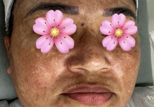 Acompanhamento de melasma