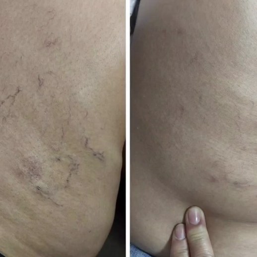 Tratamento de vasinhos nas pernas